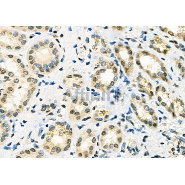 NA14 Antibody - DF12299 at 1/100 staining Human kidney cancer and adjacent normal tissues by IHC-P.