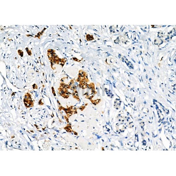 SEC24A Antibody - DF12315 at 1/100 staining Human pancreatic cancer by IHC-P.