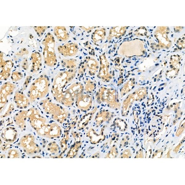 SEC24A Antibody - DF12315 at 1/100 staining Human kidney cancer and adjacent normal tissues by IHC-P.
