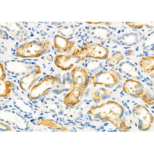 SPG11 Antibody - DF12322 at 1/100 staining Human kidney cancer and adjacent normal tissues by IHC-P.