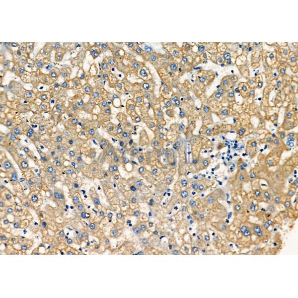 Syntaxin 16 Antibody - DF12330 at 1/100 staining Human liver cancer and adjacent normal tissues by IHC-P.