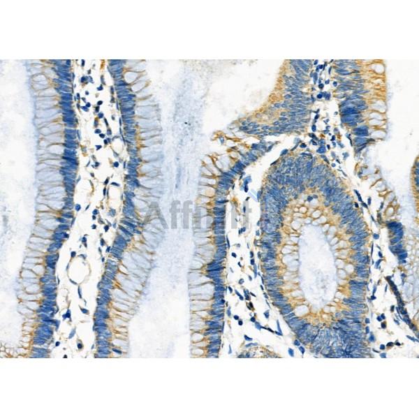 UQCRC1 Antibody - DF12338 at 1/100 staining Human colorectal cancer by IHC-P.