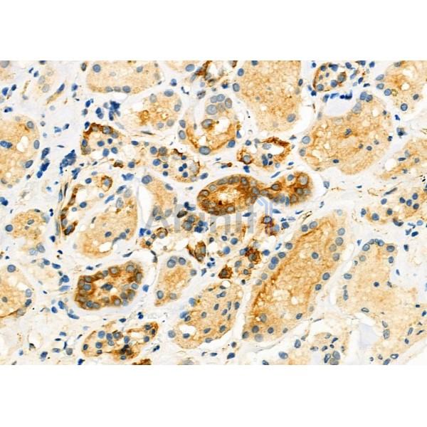 ASBT Antibody - DF12351 at 1/100 staining Human kidney cancer and adjacent normal tissues by IHC-P.