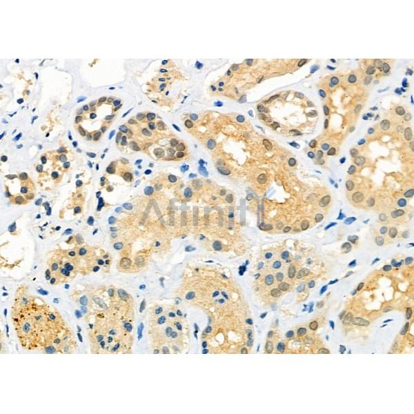 C14orf166 Antibody - DF12359 at 1/100 staining Human kidney cancer and adjacent normal tissues by IHC-P.
