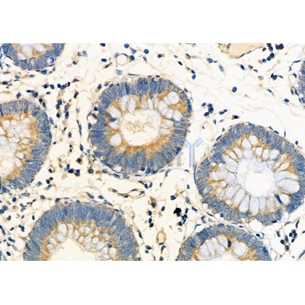 CYPC Antibody - DF12379 at 1/100 staining Human colorectal cancer by IHC-P.