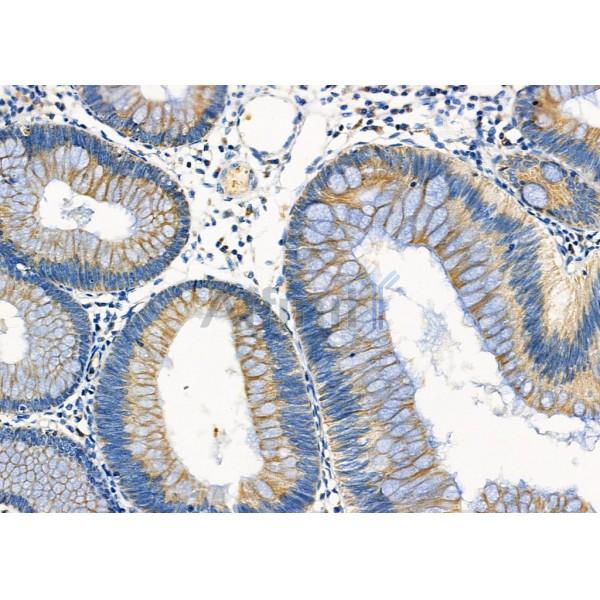 ETFA Antibody - DF12394 at 1/100 staining Human colorectal cancer by IHC-P.