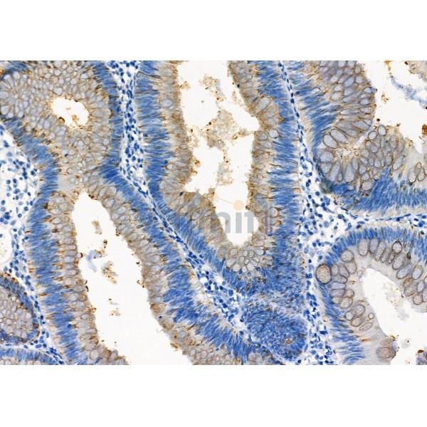 ETFDH Antibody - DF12395 at 1/100 staining Human colorectal cancer by IHC-P.