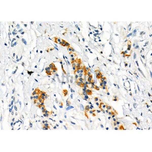 ITLN1 Antibody - DF12413 at 1/100 staining Human pancreatic cancer by IHC-P.
