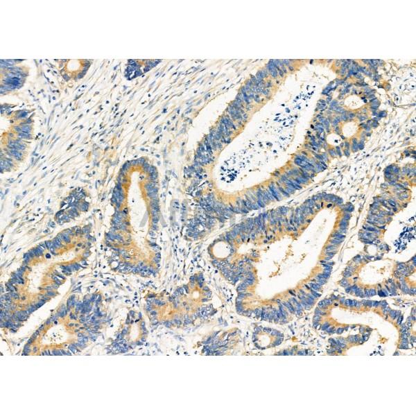 MRFAP1 Antibody - DF12424 at 1/100 staining Human colorectal cancer by IHC-P.