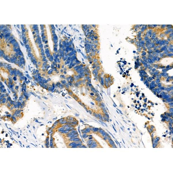 PCCA Antibody - DF12444 at 1/100 staining Human colorectal cancer by IHC-P.