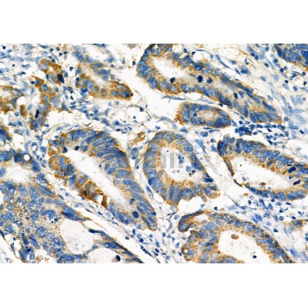 PCCA Antibody - DF12444 at 1/100 staining Human colorectal cancer by IHC-P.