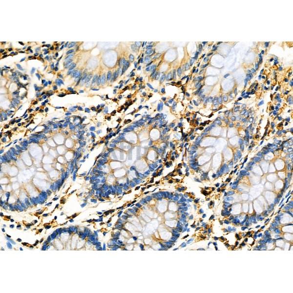 PDIA6 Antibody - DF12449 at 1/100 staining Human colorectal cancer and adjacent normal tissues by IHC-P.