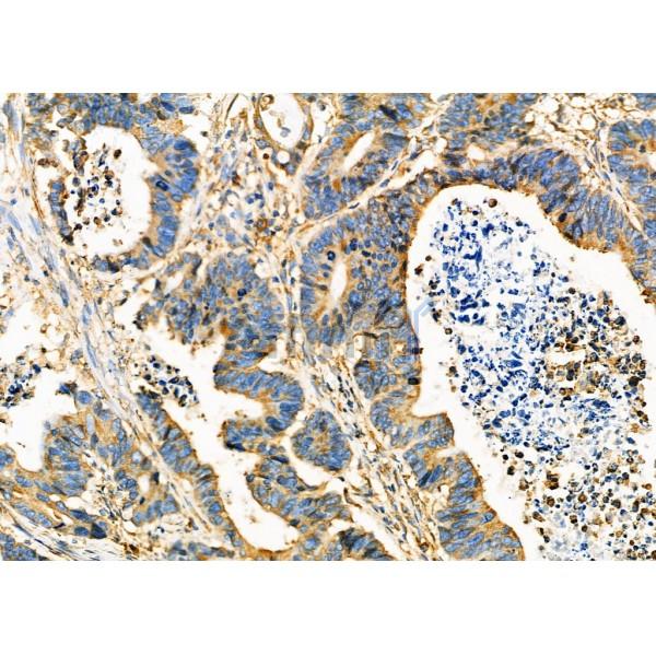 PDIA6 Antibody - DF12449 at 1/100 staining Human colorectal cancer by IHC-P.