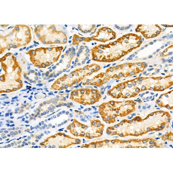 PIK3IP1 Antibody - DF12453 at 1/100 staining Human kidney cancer and adjacent normal tissues by IHC-P.