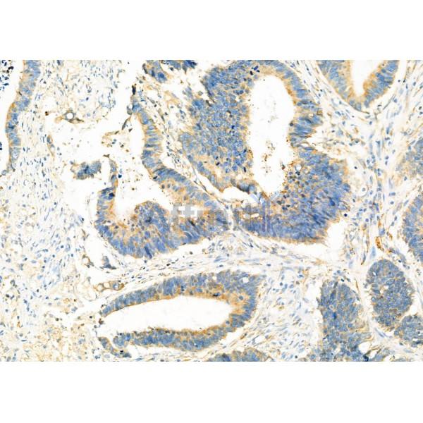 SLC25A46 Antibody - DF12476 at 1/100 staining Human colorectal cancer by IHC-P.