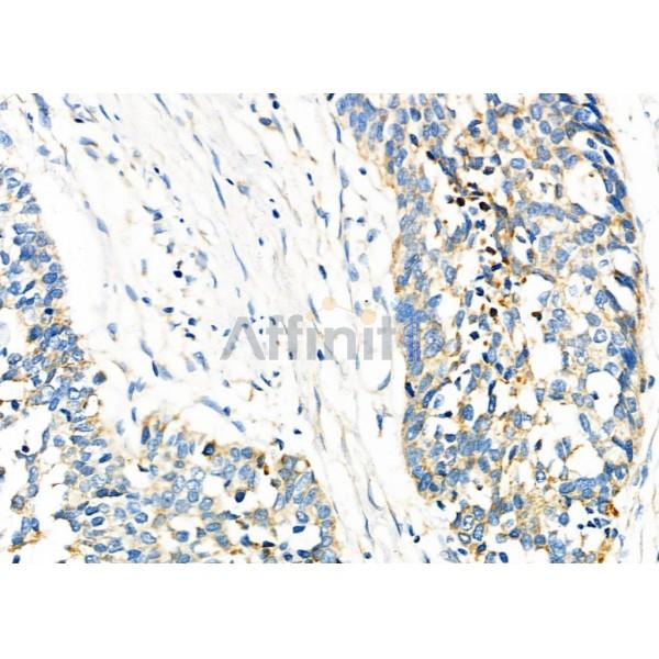 TIMM9 Antibody - DF12487 at 1/100 staining Human esophageal cancer by IHC-P.