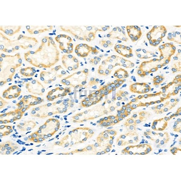 TIMM9 Antibody - DF12487 at 1/100 staining Human kidney cancer and adjacent normal tissues by IHC-P.