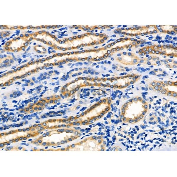 ASPP1 Antibody - DF2274 at 1/100 staining Human kidney cancer and adjacent normal tissues by IHC-P.