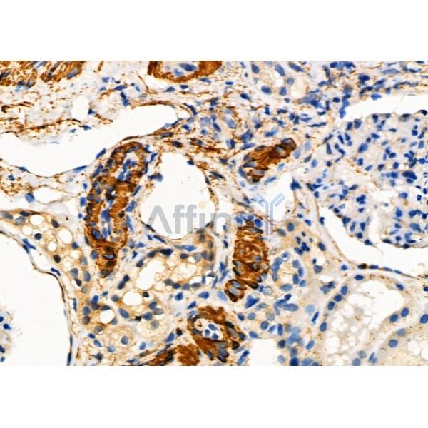 PAEP Antibody - DF2701 at 1/100 staining Human kidney cancer and adjacent normal tissues by IHC-P.