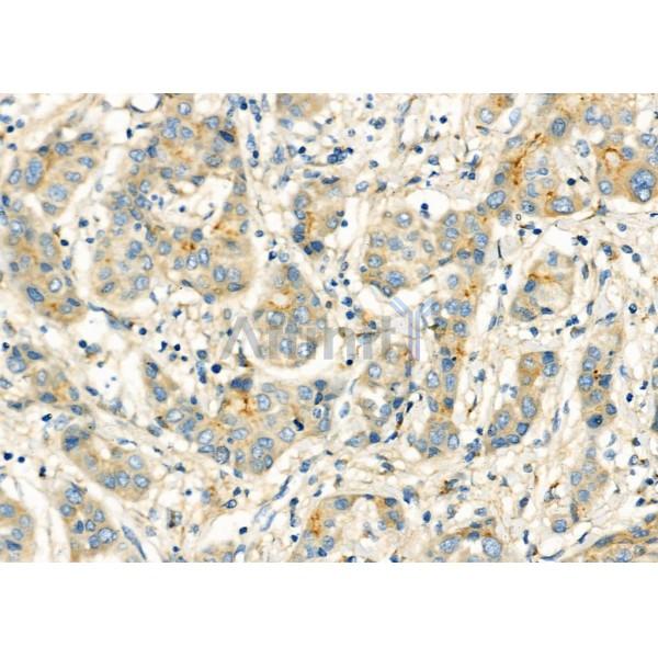 CHP2 Antibody - DF3860 at 1/100 staining Human liver cancer by IHC-P.