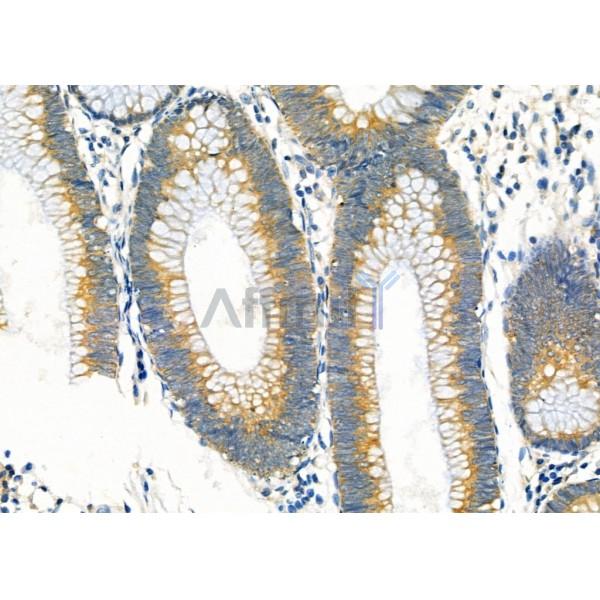 BORG2 Antibody - DF3909 at 1/100 staining Human colorectal cancer by IHC-P.