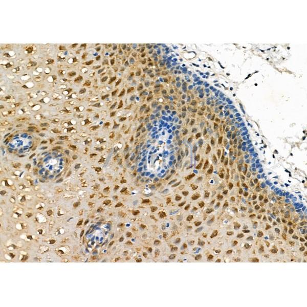 CRABP2 Antibody - DF3914 at 1/100 staining Human esophageal cancer and adjacent normal tissues by IHC-P.