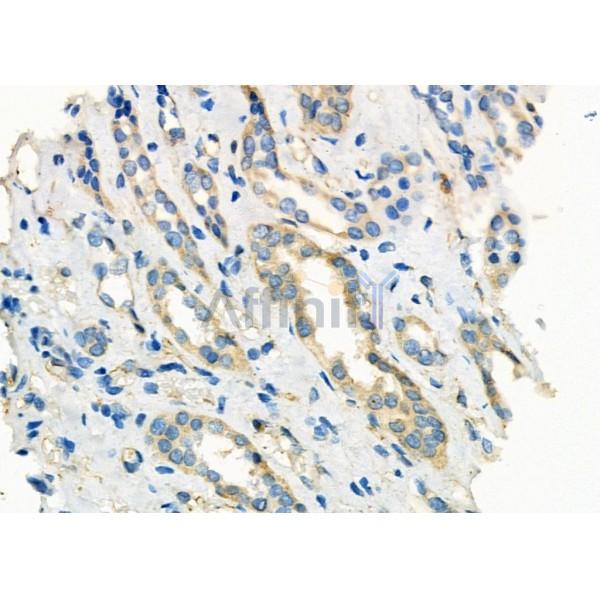 CLCN7 Antibody - DF3932 at 1/100 staining Human kidney cancer and adjacent normal tissues by IHC-P.
