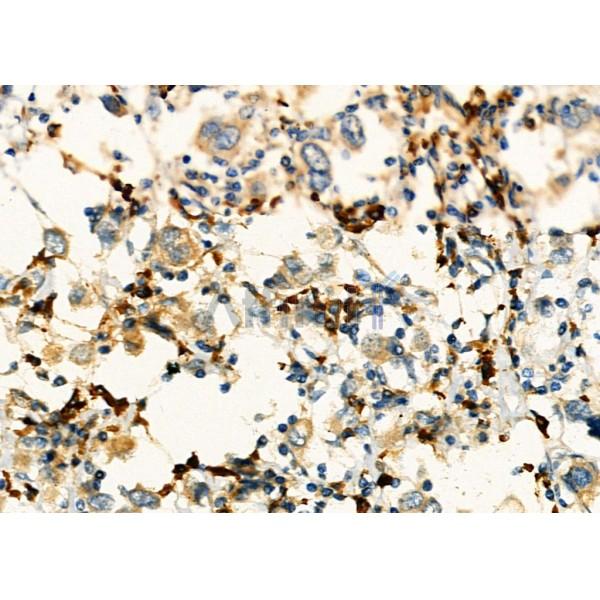 KIF4A Antibody - DF3941 at 1/100 staining Human mammary cancer by IHC-P.