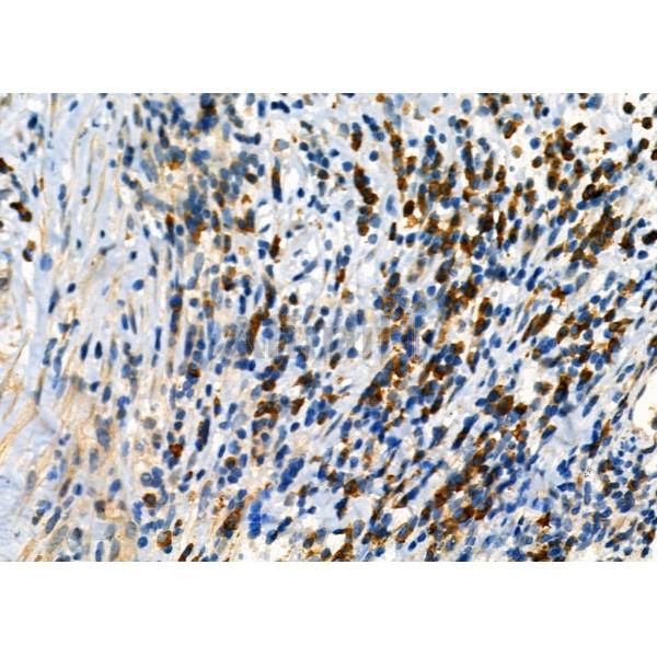 KIF4A Antibody - DF3941 at 1/100 staining Human ovarian cancer by IHC-P.