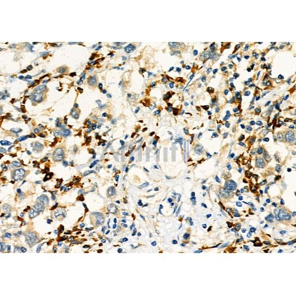 KIF4A Antibody - DF3941 at 1/100 staining Human mammary cancer by IHC-P.