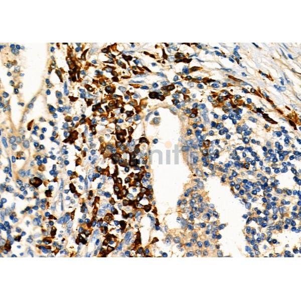 KIF4A Antibody - DF3941 at 1/100 staining Human lung cancer by IHC-P.