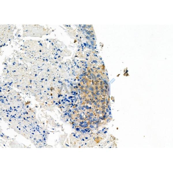INSL4 Antibody - DF4030 at 1/100 staining Human pancreatic cancer by IHC-P.