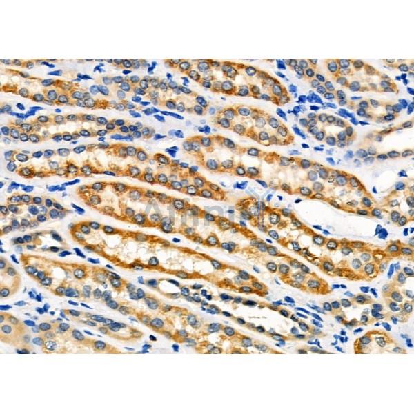 NXPH1 Antibody - DF4230 at 1/100 staining Human kidney cancer and adjacent normal tissues by IHC-P.