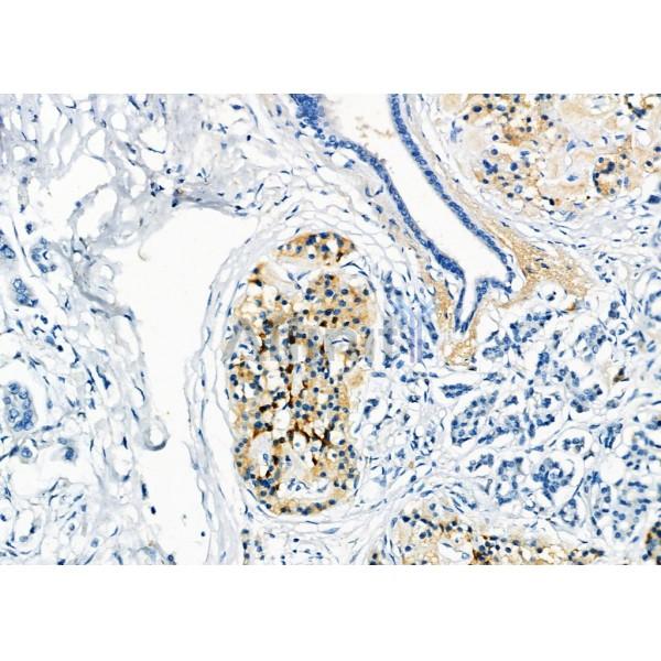 RAB20 Antibody - DF4396 at 1/100 staining Human pancreatic cancer by IHC-P.