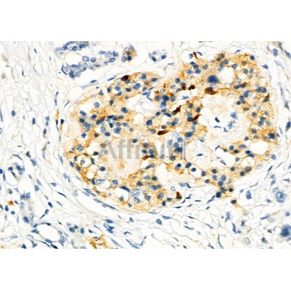 RAB20 Antibody - DF4396 at 1/100 staining Human pancreatic cancer by IHC-P.