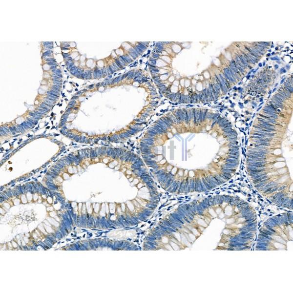 ZFYVE19 Antibody - DF4625 at 1/100 staining Human colorectal cancer by IHC-P.