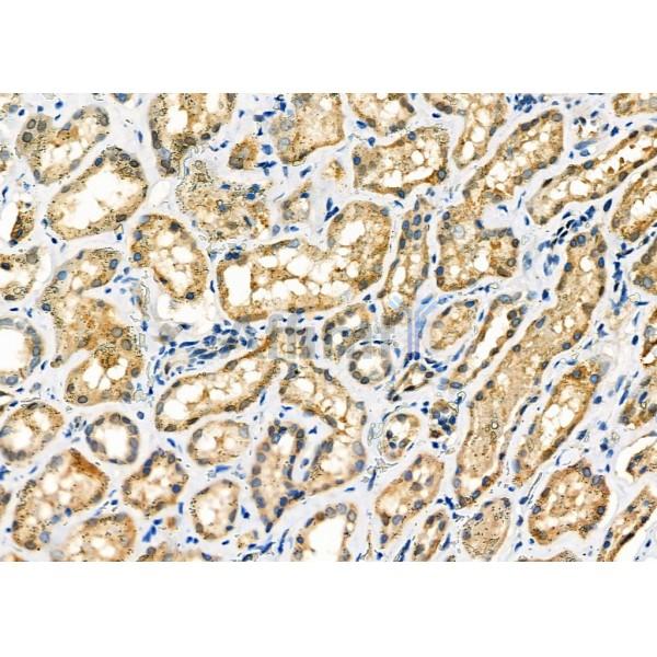 ZFYVE19 Antibody - DF4625 at 1/100 staining Human kidney cancer and adjacent normal tissues by IHC-P.