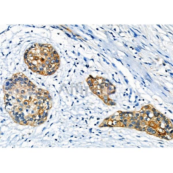 GPR87/GPR95 Antibody - DF4978 at 1/100 staining Human esophageal cancer by IHC-P.