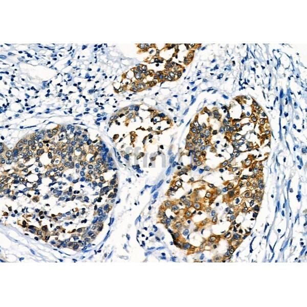 GPR87/GPR95 Antibody - DF4978 at 1/100 staining Human esophageal cancer by IHC-P.