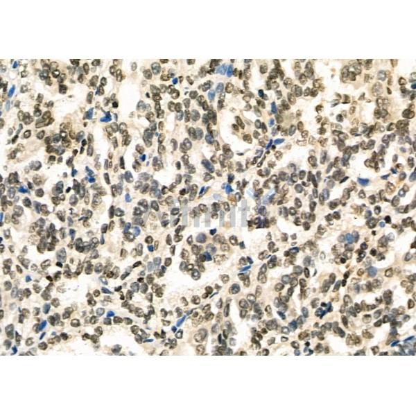 TAP2 Antibody - DF6498 at 1/100 staining Human kidney cancer by IHC-P.