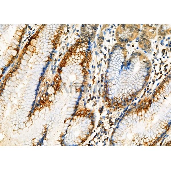 IPO5 Antibody - DF6735 at 1/100 staining Human gastric cancer and adjacent normal tissues by IHC-P.