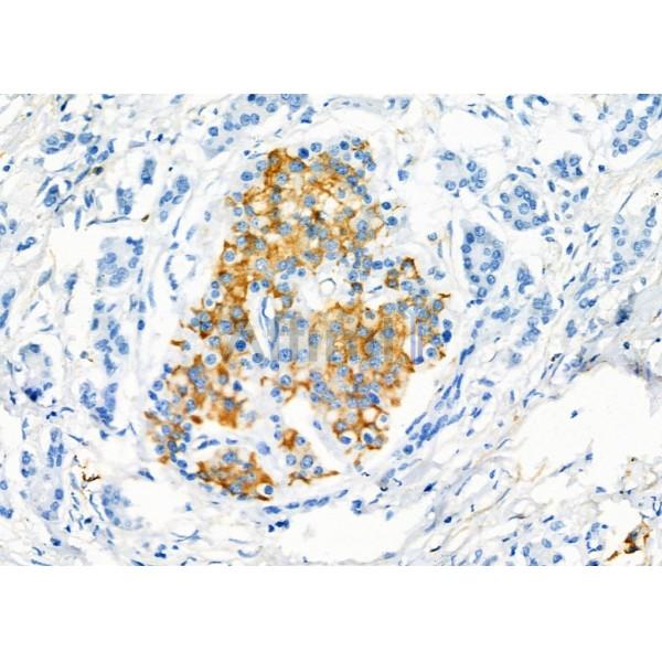 TPSAB1 Antibody - DF6758 at 1/100 staining Human gastric cancer by IHC-P.