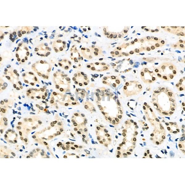 ILF3 Antibody - DF6965 at 1/100 staining Human kidney cancer and adjacent normal tissues by IHC-P.