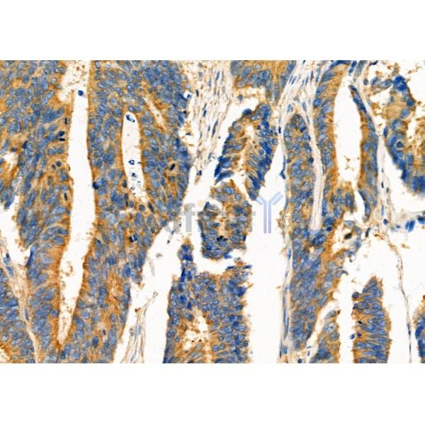 TRAP1 Antibody - DF7073 at 1/100 staining Human colorectal cancer by IHC-P.