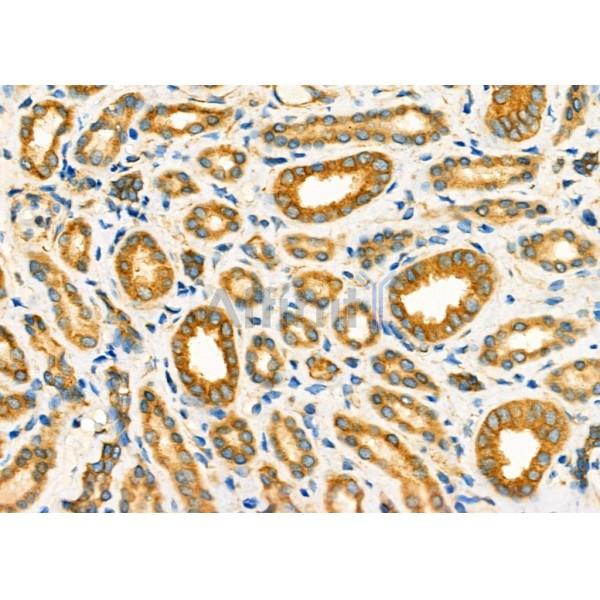 TRAP1 Antibody - DF7073 at 1/100 staining Human kidney cancer and adjacent normal tissues by IHC-P.