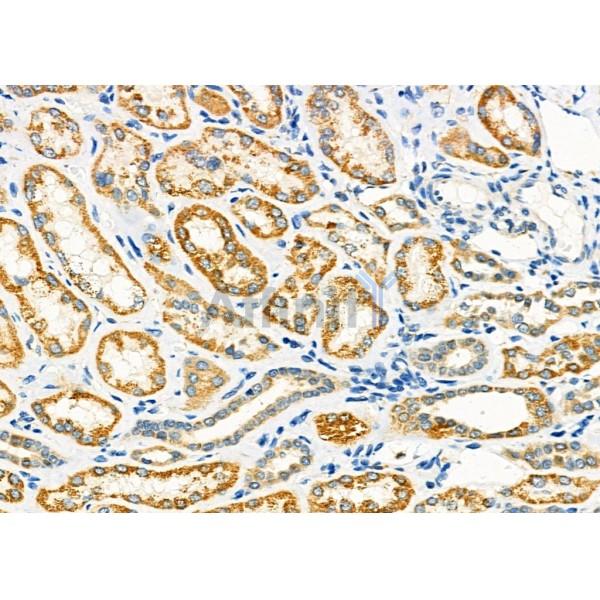 PDK4 Antibody - DF7169 at 1/100 staining Human kidney cancer and adjacent normal tissues by IHC-P.