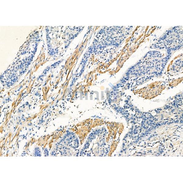 Calponin Antibody - DF7671 at 1/100 staining Human esophageal cancer by IHC-P.