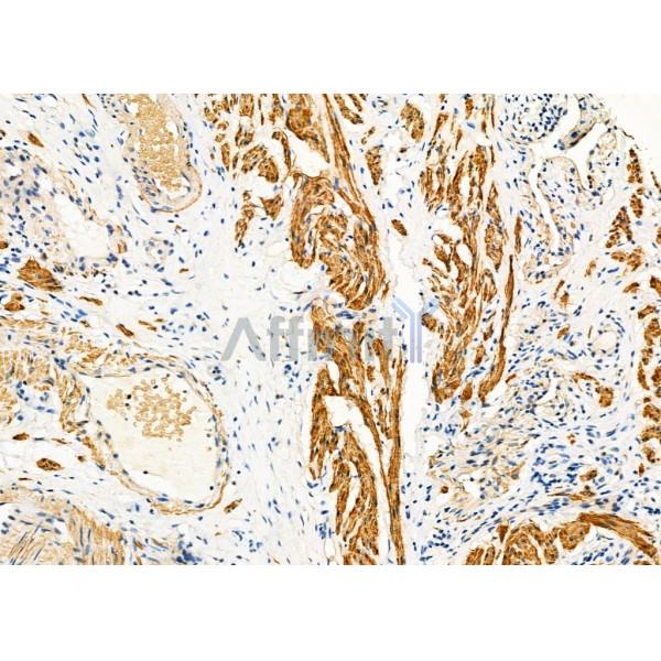 Calponin Antibody - DF7671 at 1/100 staining Human ovarian cancer by IHC-P.