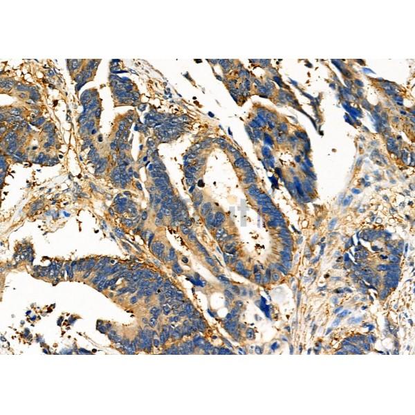 CD166 Antibody - DF7736 at 1/100 staining Human colorectal cancer by IHC-P.