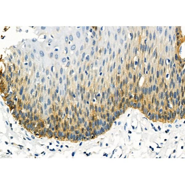 ANO1 Antibody - DF7769 at 1/100 staining Human esophageal cancer and adjacent normal tissues by IHC-P.
